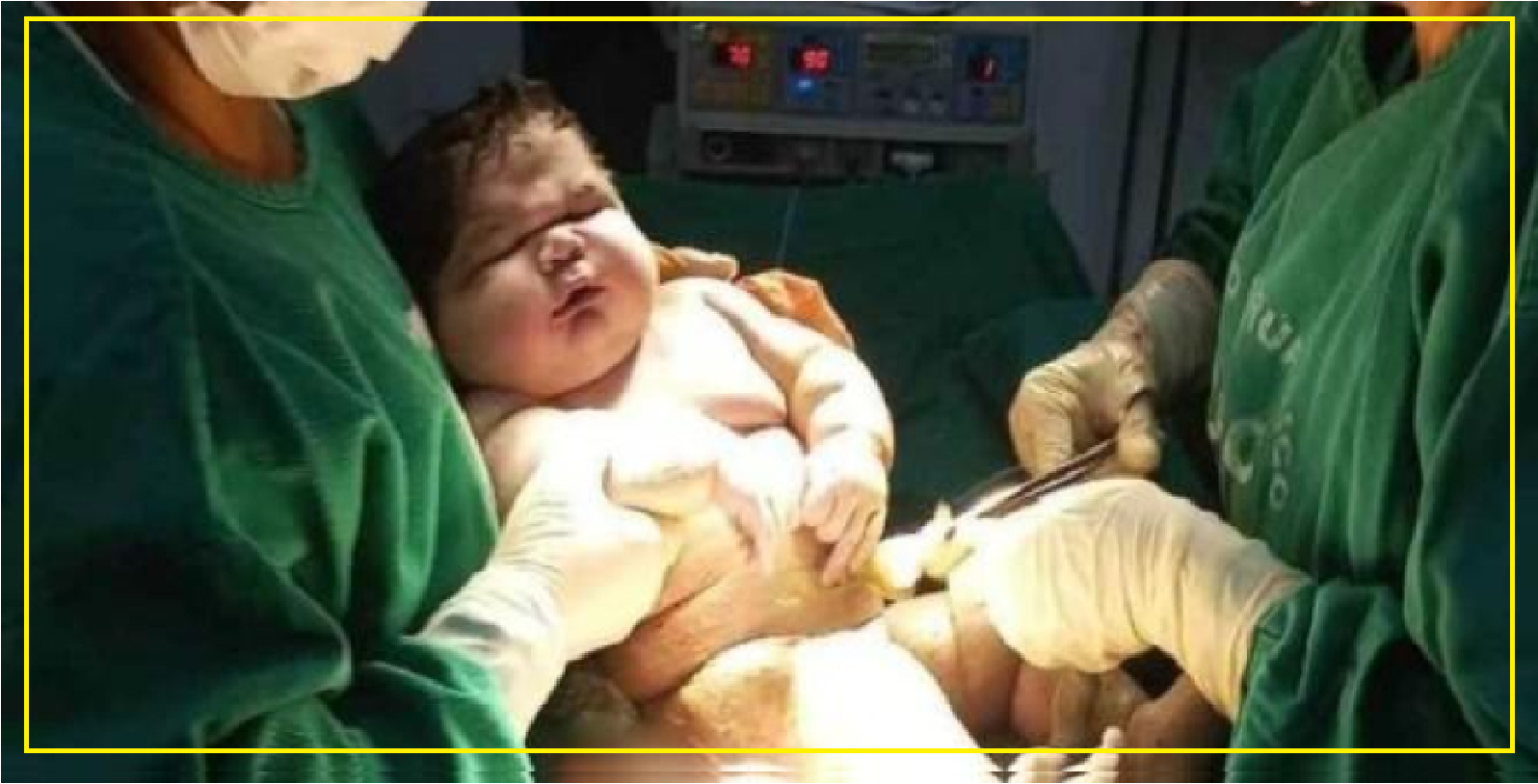 El asombroso nacimiento de un bebé de 5.1 kg en Brasil causa sensación